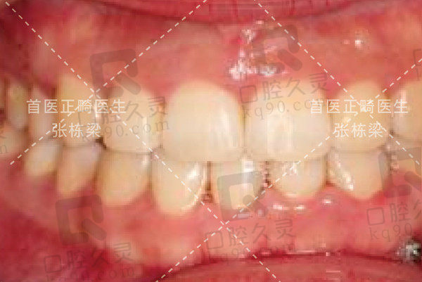 矫正后