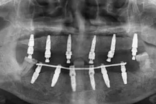 全口种植牙牙片