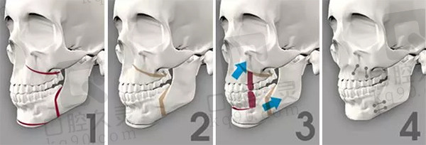 何锦泉正颌手术步骤