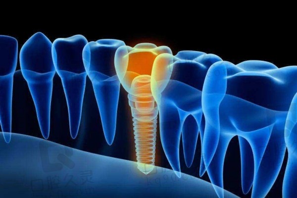 种植牙概念图