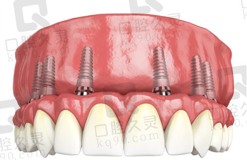 全口牙缺失在杭州雅莱口腔做种植牙全过程分享
