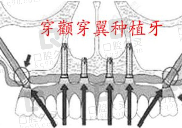 穿颤穿翼种植牙技术