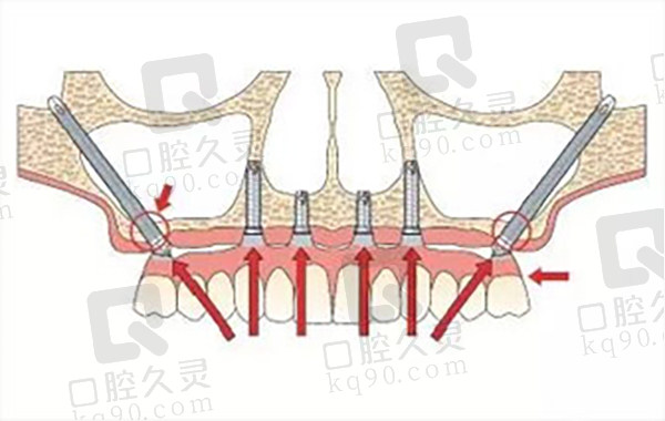 成都布莱梅口腔穿颧穿翼种植技术好