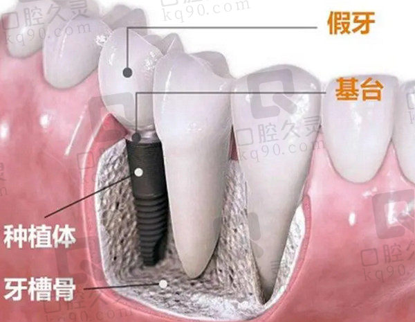 种植牙