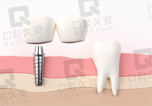 广州镶牙去哪家医院比较好？