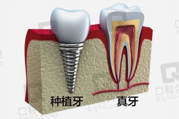 种植牙与真牙