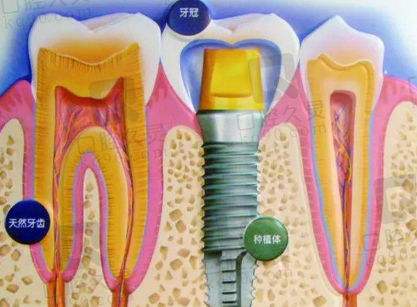 种植牙