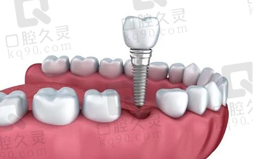口腔医院在线咨询关于种植牙的常见问题解答