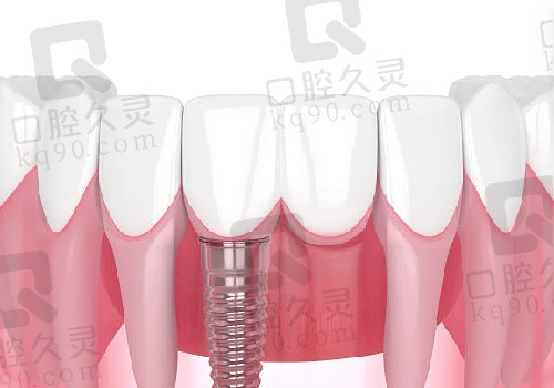  深圳正夫种植牙图