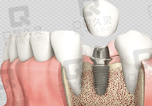  美奥口腔种植牙图
