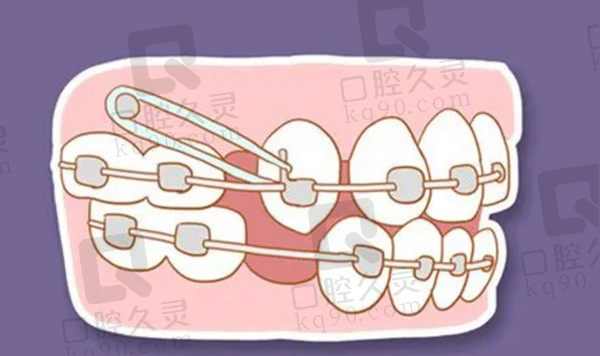 牙齿矫正