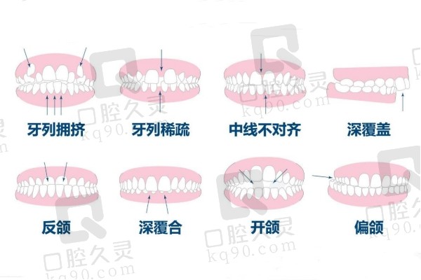 牙齿畸形类型