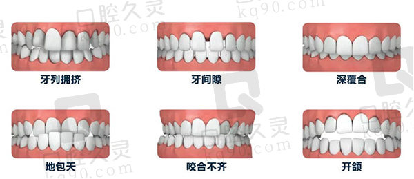 什么情况下需要做牙齿矫正