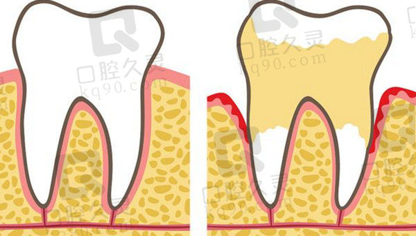牙龈萎缩