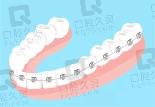 厦门麦芽口腔牙齿矫正价格