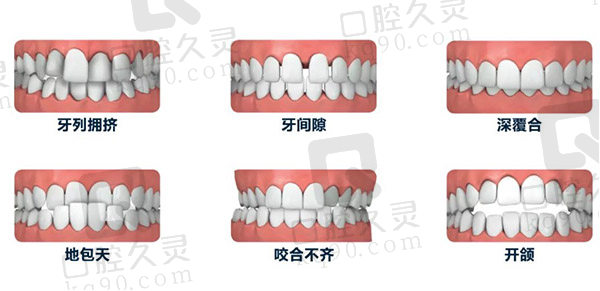 什么情况下需要做牙齿矫正