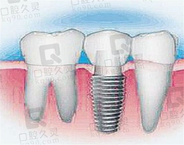植牙疗效不同