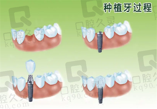  重庆种植牙过程图