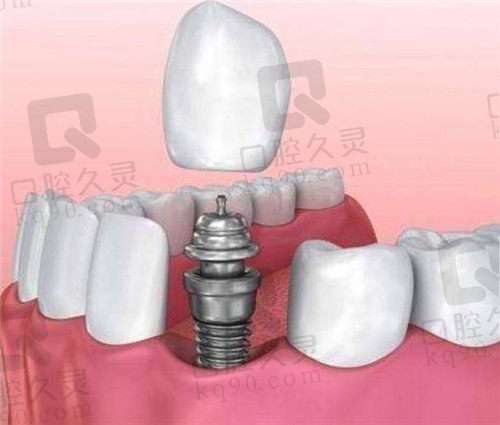 即拔即种植牙劣势