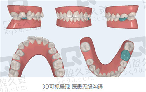 重庆团圆口腔医院种一颗牙多少钱