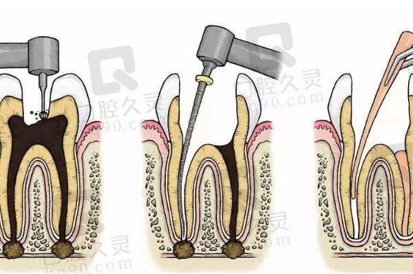 根管治疗