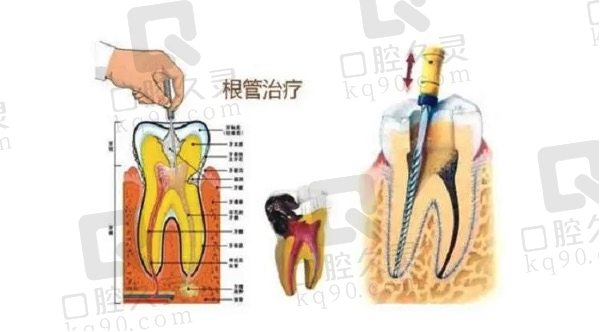 根管治疗