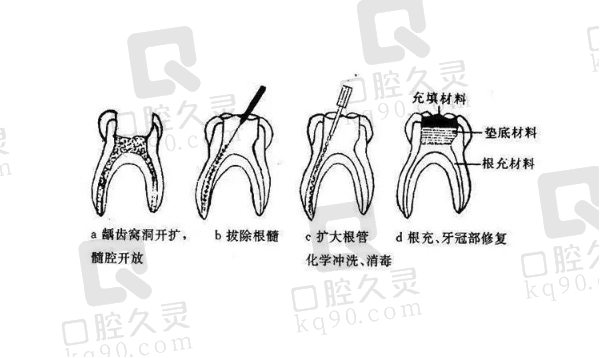 根管治疗