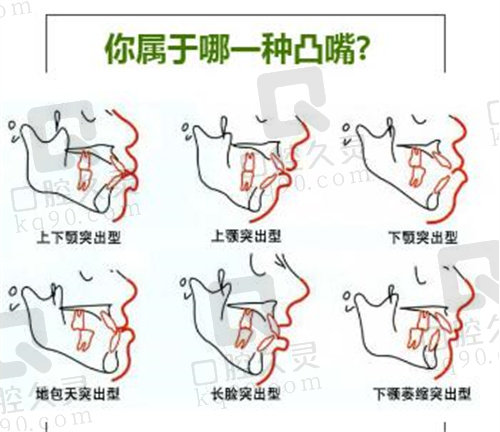 广州美恩口腔凸嘴类型