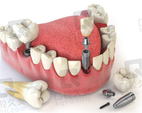 种植牙的特点