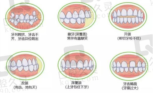 各类型凸嘴矫正