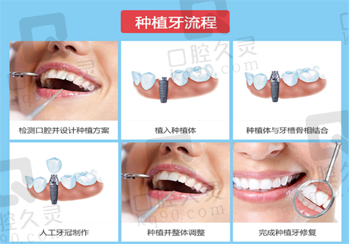 沧州口腔医院种植牙流程图