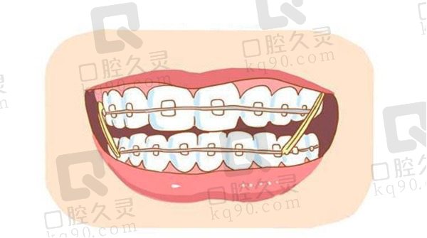 牙齿矫正