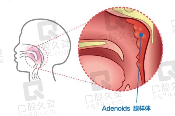 腺样体