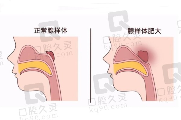 腺样体对比