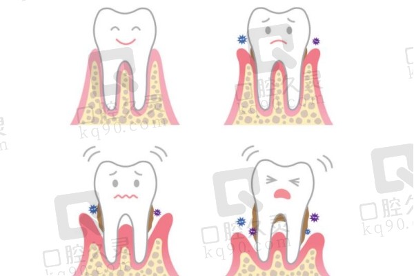 牙周炎