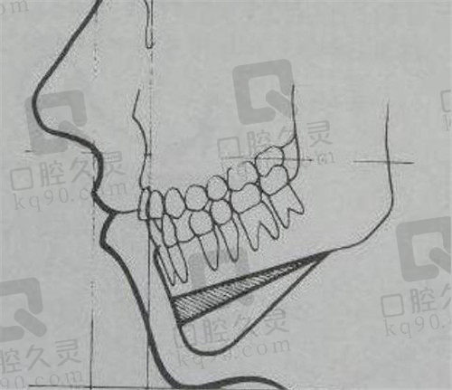 下颌后退