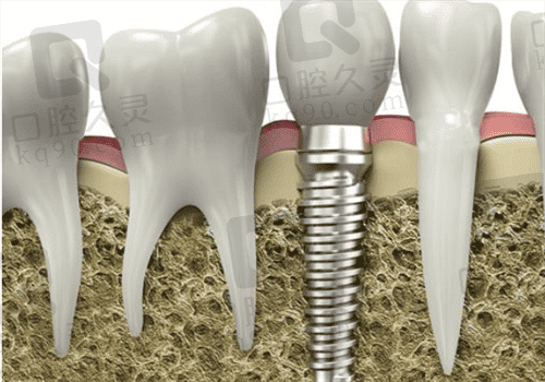 金华口腔种植牙图