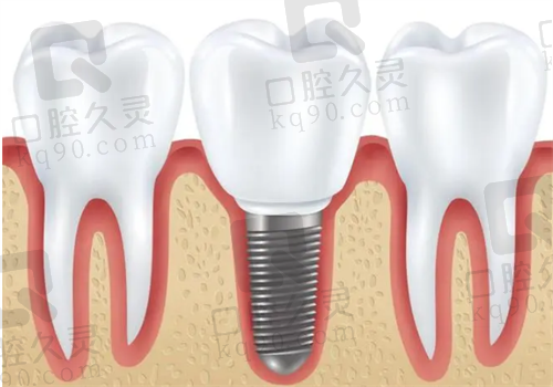 金华口腔种植牙图