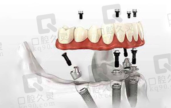 all-on-4种植牙技术