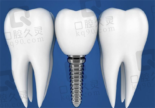 恩施凯恩口腔医院种植牙