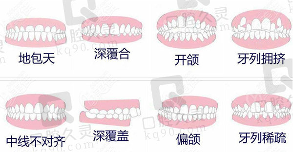 牙齿矫正方式