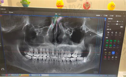 衡水阜城安康口腔牙片