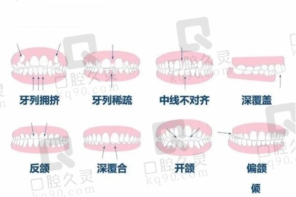 牙齿畸形类型