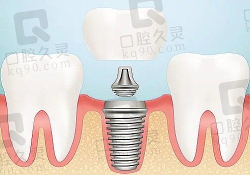 种植牙图片