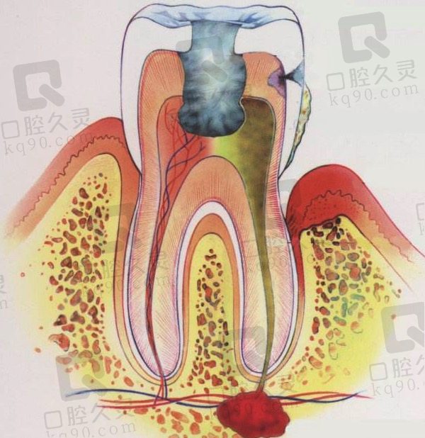 根管治疗