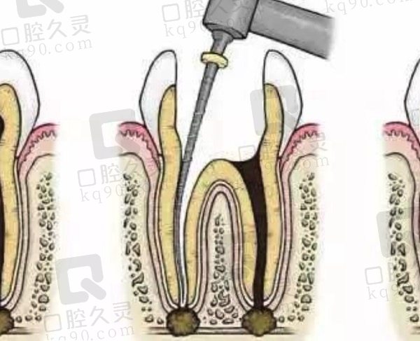 根管治疗