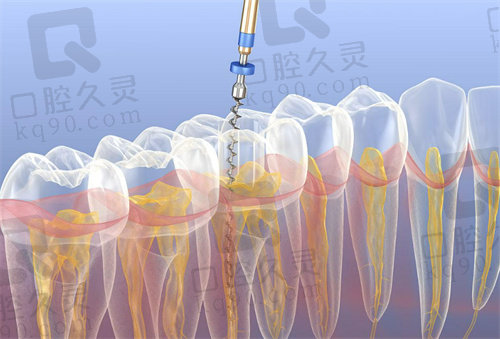 东莞根管治疗怎么样