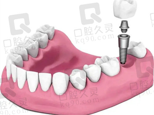 上海西朗美口腔半口种植牙示意图