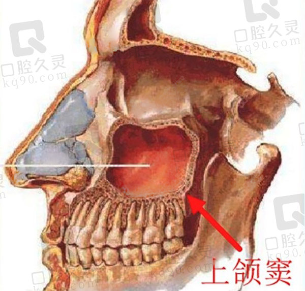 上颌窦提升