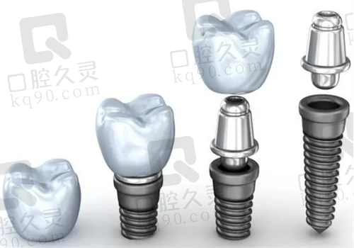 成都口腔医院种植牙